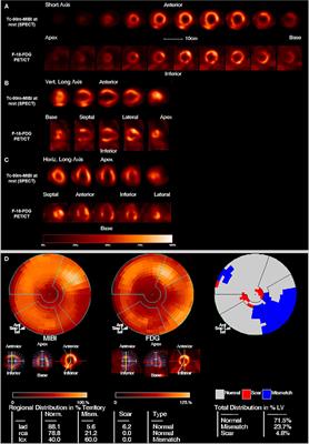 Non-invasive Imaging in Patients With Chronic Total Occlusions of the Coronary Arteries—What Does the Interventionalist Need for Success?